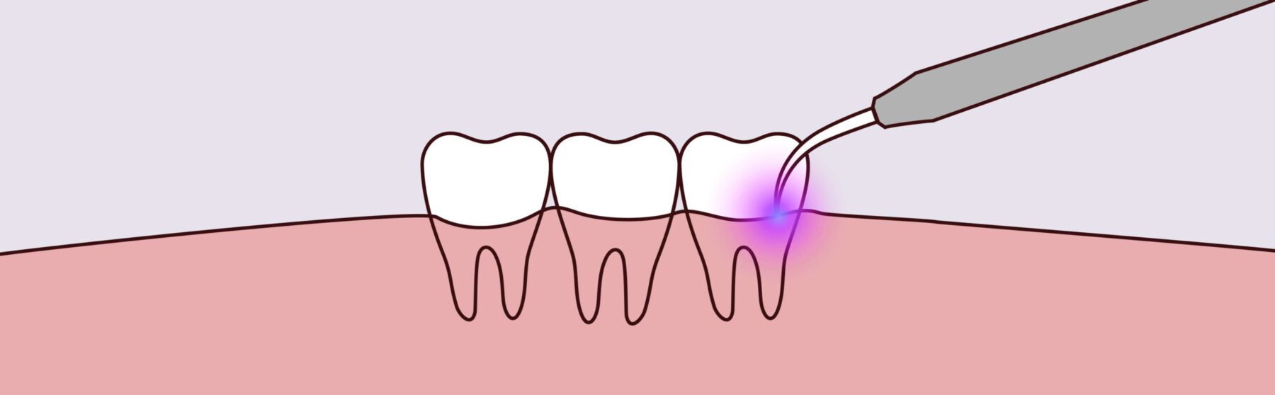 Laser Therapy -