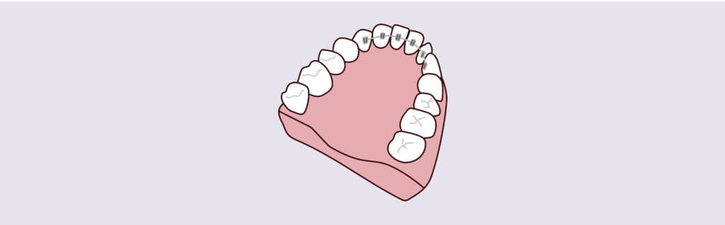Lingual Braces -