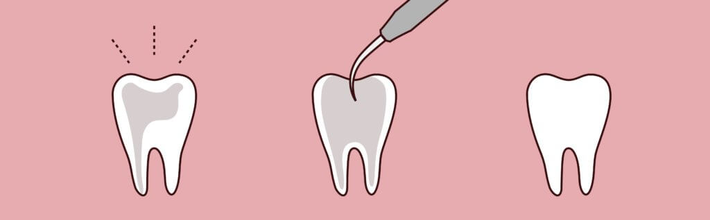 Root Canal Therapy -
