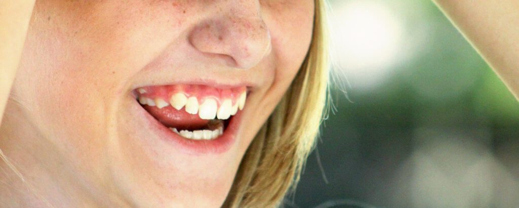 Root Resorption -