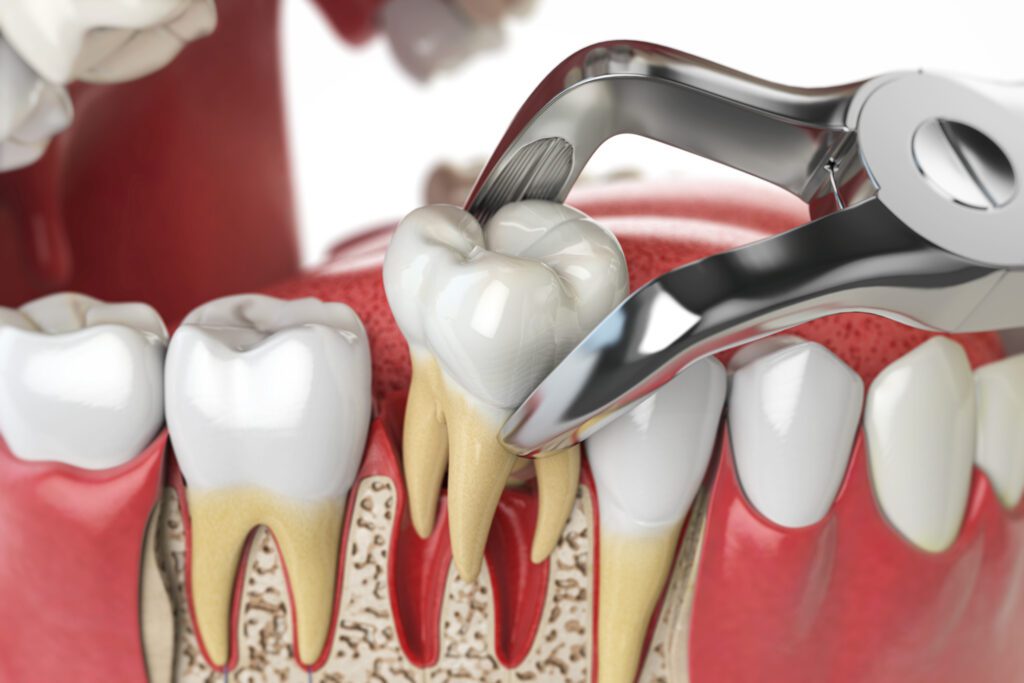 Tooth Extractions -