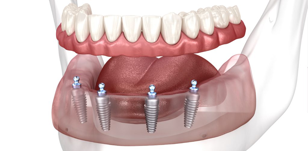 full-arch implants dentist St. Joseph